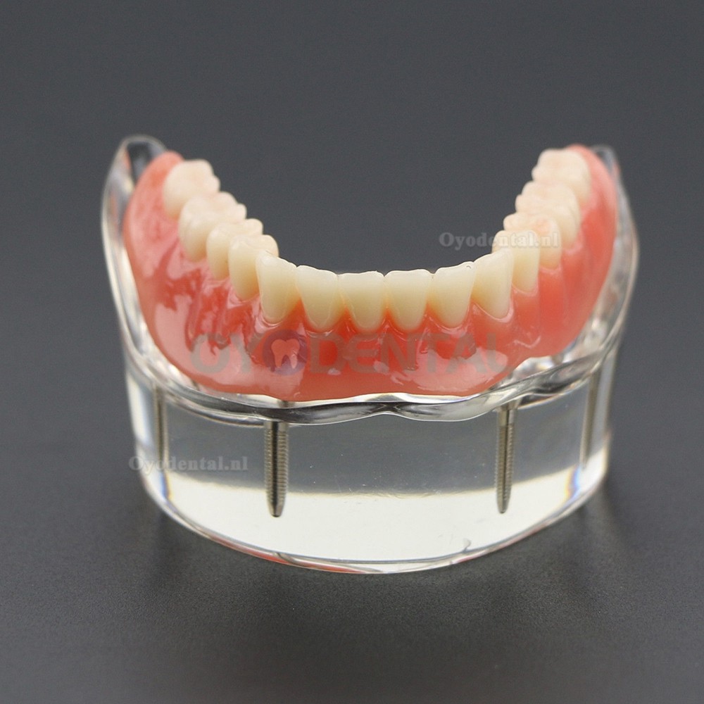 Demo-onderzoek tandheelkundige onderste tanden Model 6002 02 Overdenture Inferior 4 implantaten